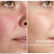 Beta-Glucan gegen Hautrötungen