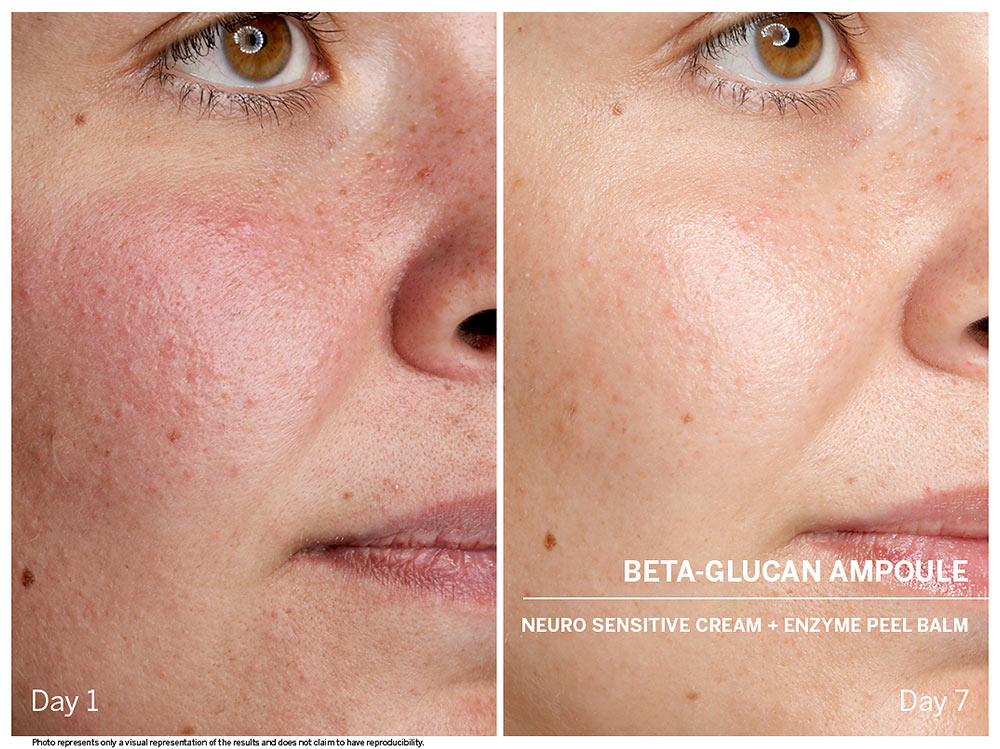 Beta-Glucan gegen Hautrötungen