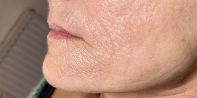 Secret RF Needling Oberhausen