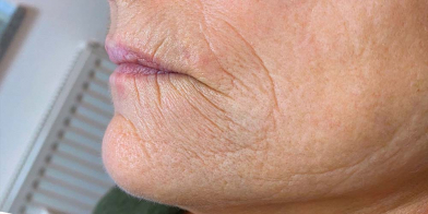 Secret RF Needling Oberhausen