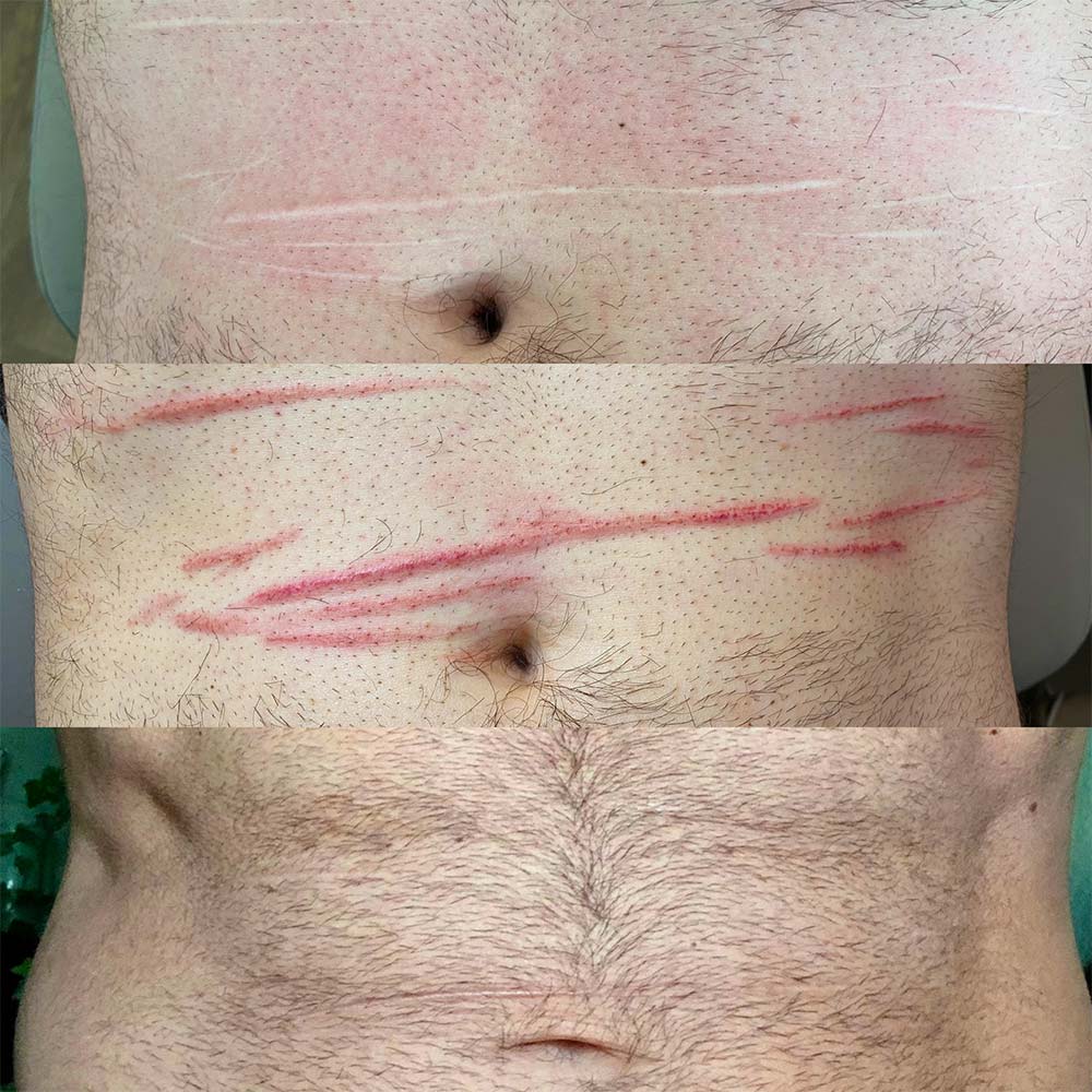 Narbenretusche Medizinische Tätowierung Sara Pavo Cosmetics Narbenretusche Medizinische Tätowierung Sara Pavo Cosmetics