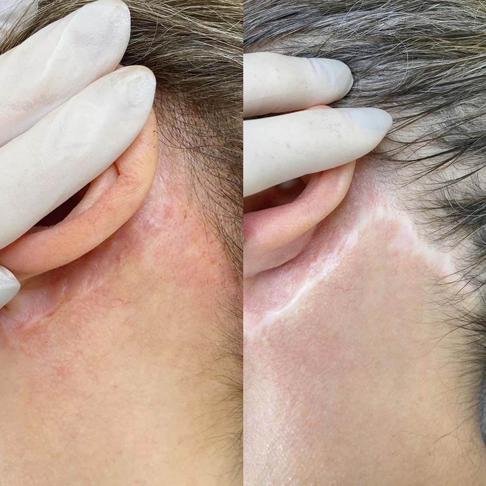 Narbenretusche Medizinische Tätowierung Sara Pavo Cosmetics Narbenretusche Medizinische Tätowierung Sara Pavo Cosmetics