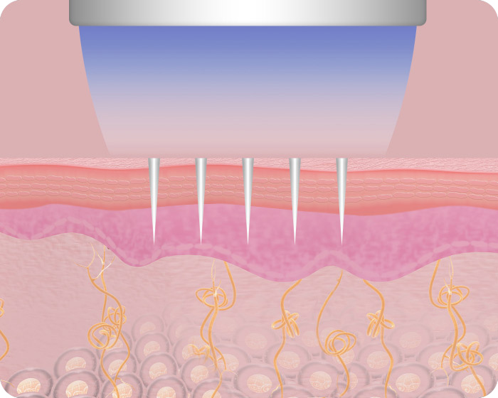 Schritt 2 Secret RF Radiofrequenz Needling