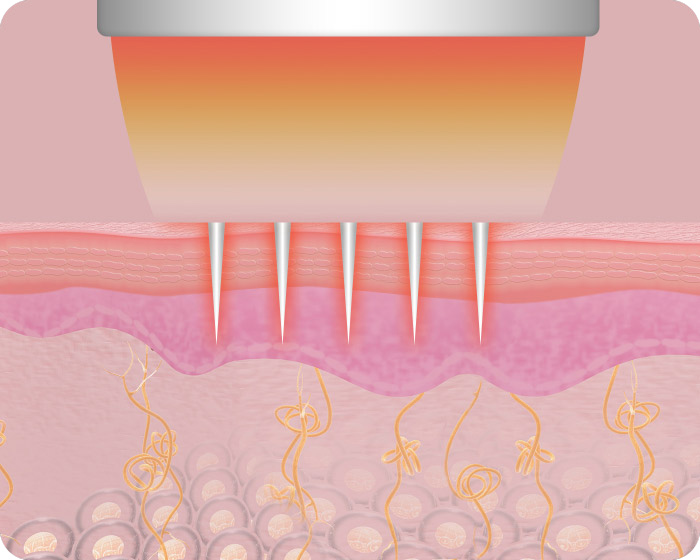 Schritt 3 Secret RF Radiofrequenz Needling