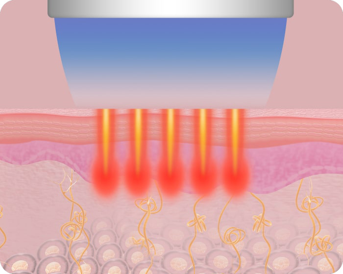 Schritt 4 Secret RF Radiofrequenz Needling