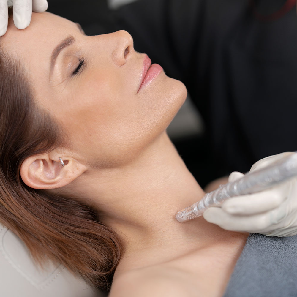 microneedling-oberhausen-essen-sarapavocosmetics